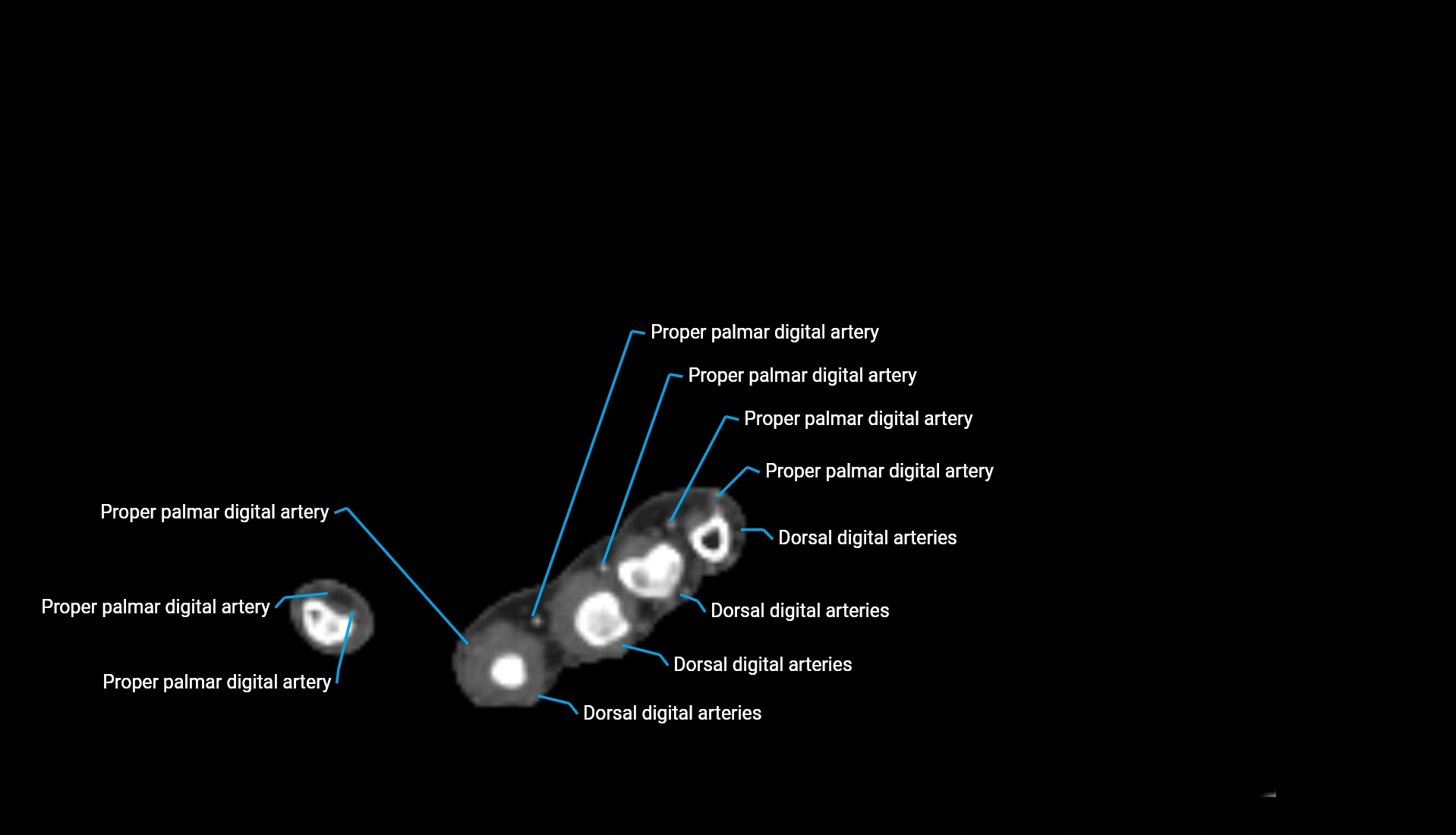 CTA upper limb axial cross sectional anatomy labelled image 44 (2).webp